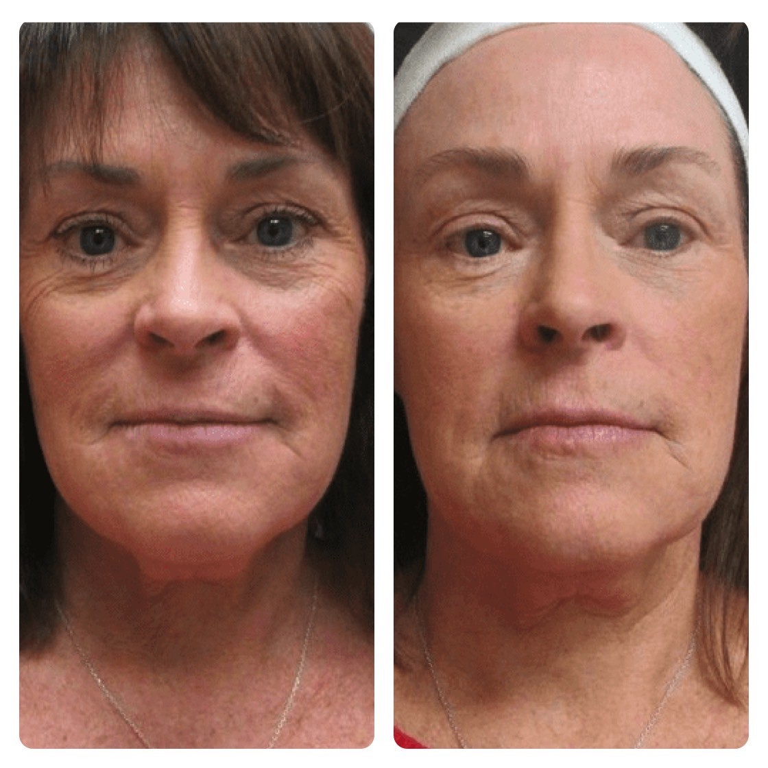 Before and after results of an RF morpheus8 microneedling treatment, Oahu.