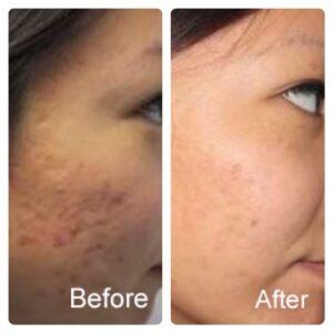 Before and after showing how melasma treatment works.