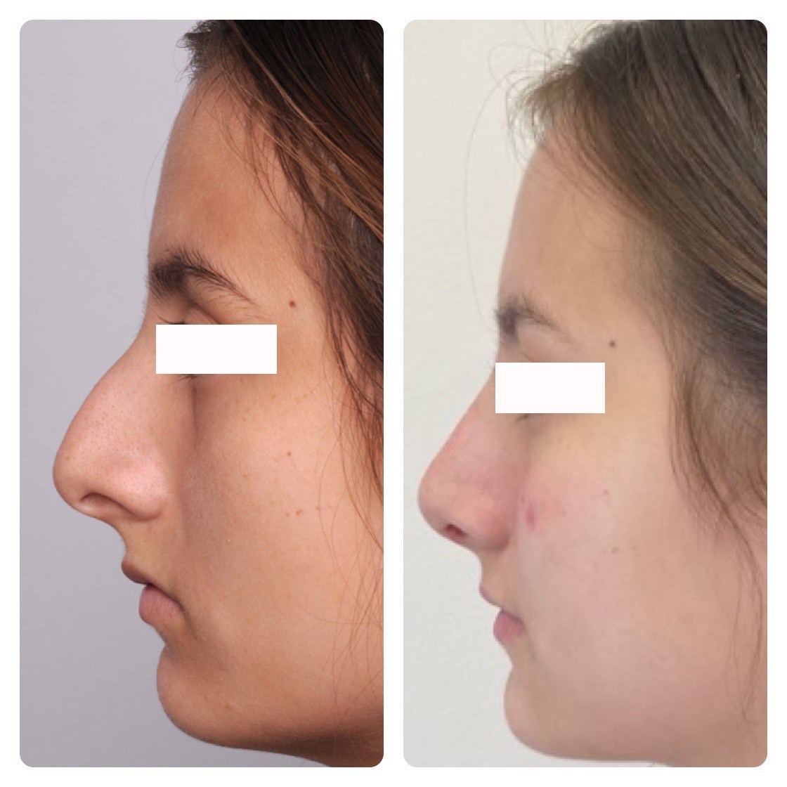 Before and after nose surgery, Honolulu. 