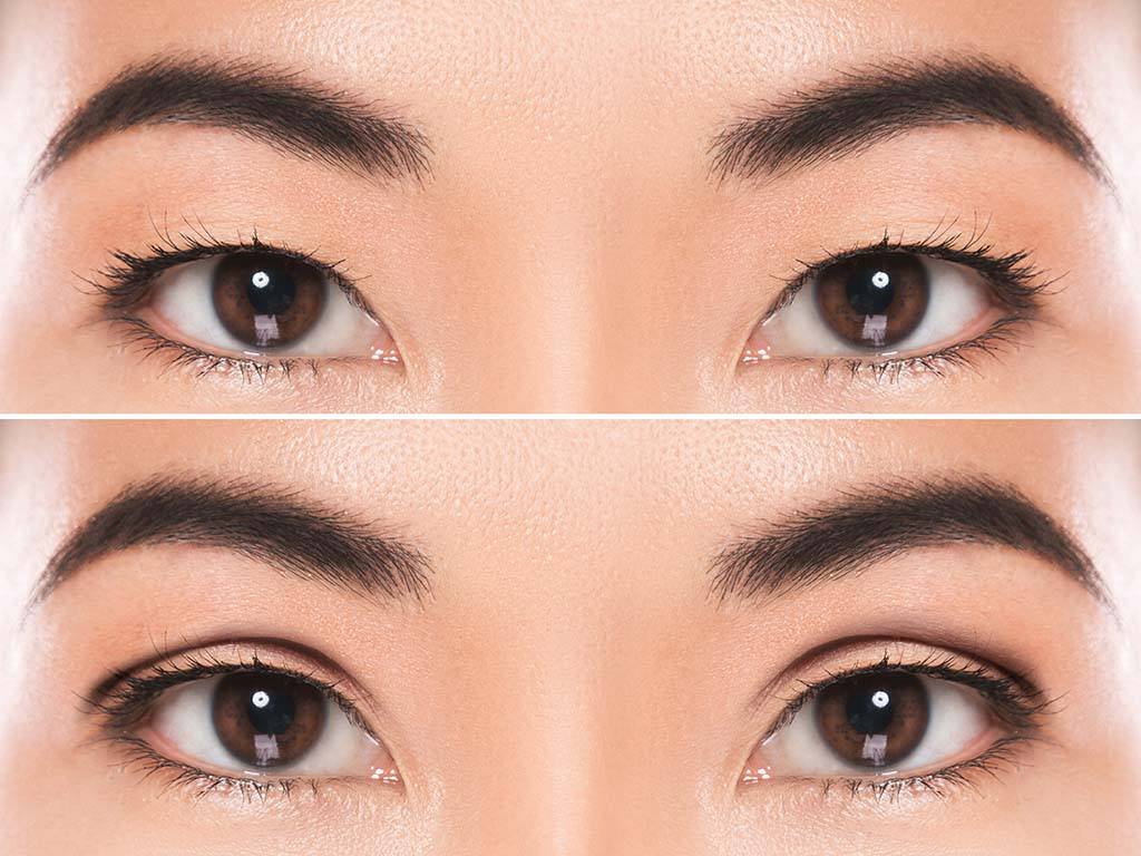 Honolulu Asian eyelid surgery near me. Asian double eyelid surgery, Honolulu. Clinic for Asian Blepharoplasty, Oahu.