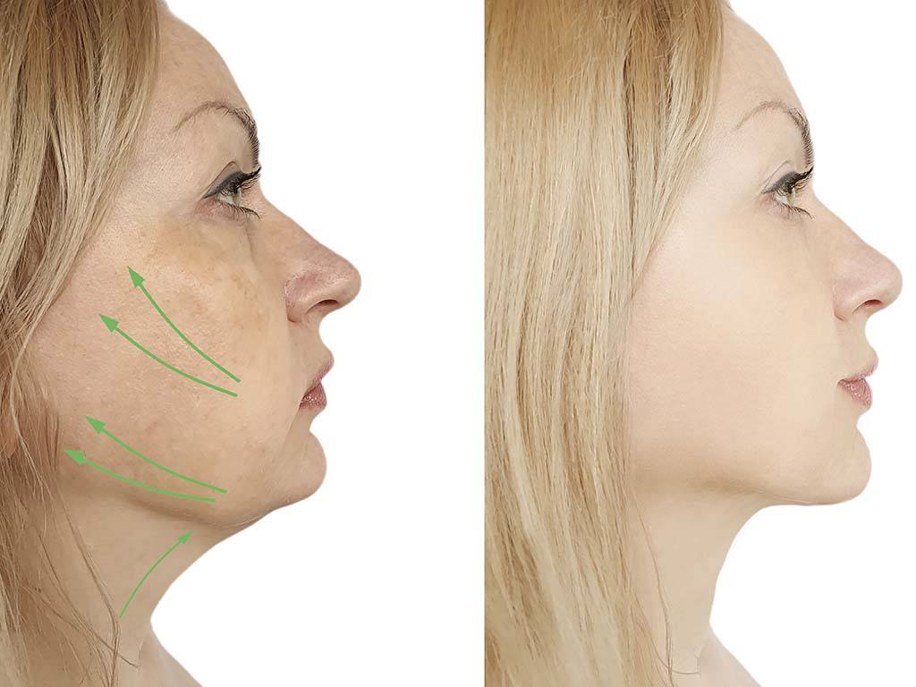 Before and after of chin liposuction, Honolulu HI.