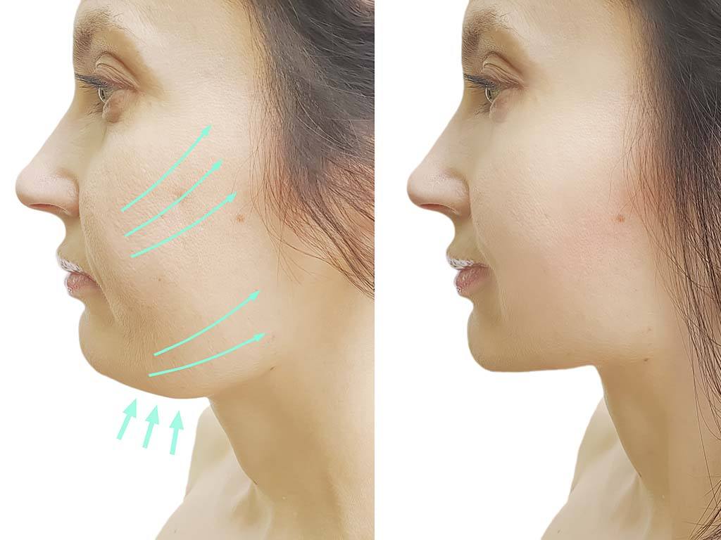 Before and after of neck liposuction, Honolulu, Hawaii. Licensed plastic surgeon for liposuction. 