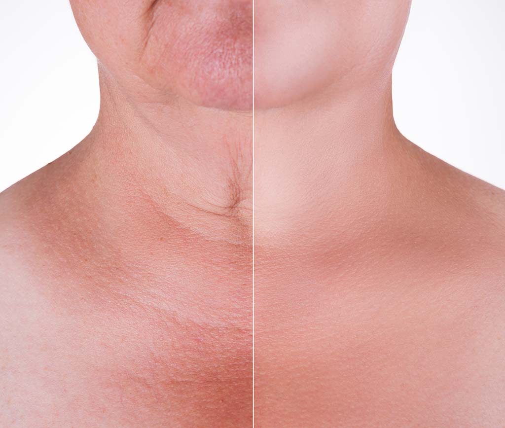 Split image showing before and after necklift surgery, Honolulu, HI.