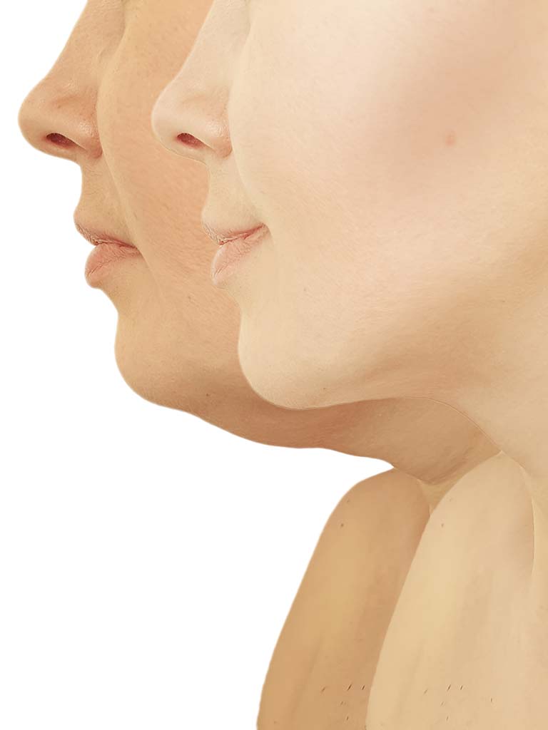 Honolulu neck liposuction procedure before and after. Best neck liposuction, Oahu, Hawaii.