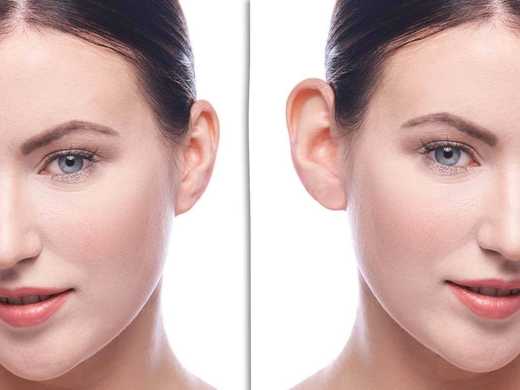 Smooth and Streamline Your Cheeks