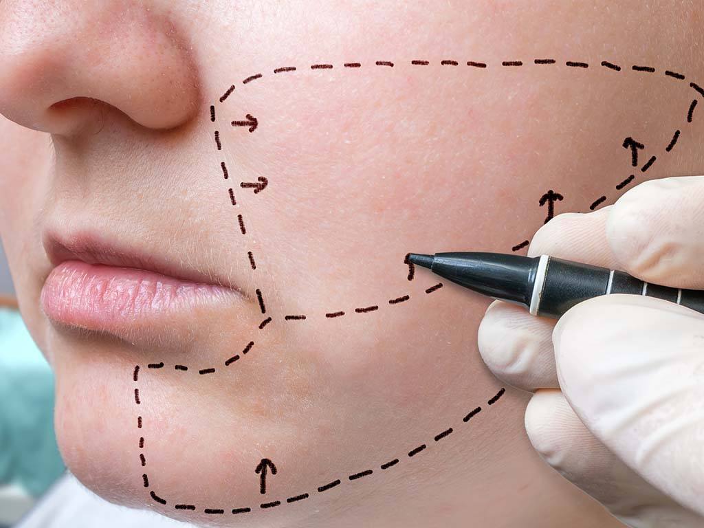 Honolulu buccal fat removal surgeon makes marks for sculpting and cheek fat removal, Oahu, Hawaii.