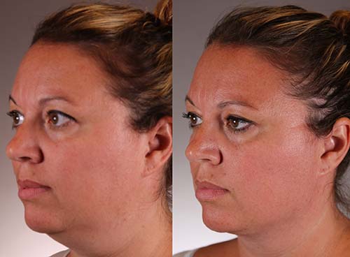 Hollywood spectra short-pulse laser to treat melasma and other skin conditions, Honolulu HI. Skin treatment laser.