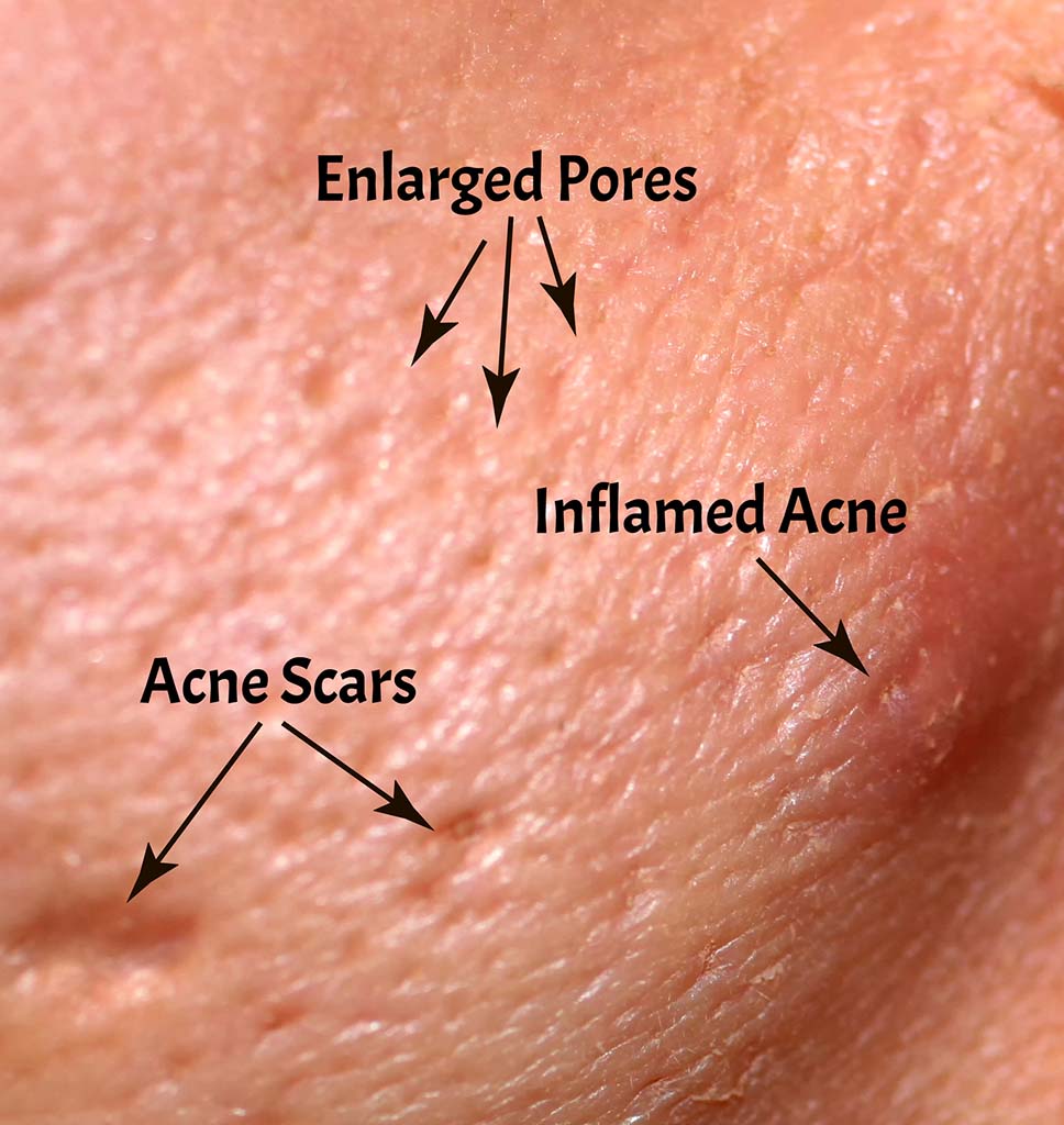 Acne causes scars, enlarged pores, inflamed areas. Oahu acne scar, Honolulu treatments with Dr. Susan Tan.