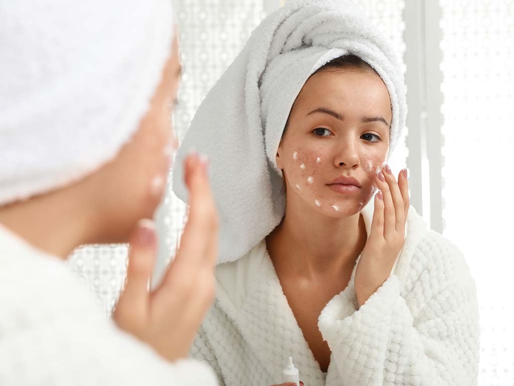 Resident in Hawaii treating acne with OTC (over-the-counter) medication. Acne treatment in Honolulu.