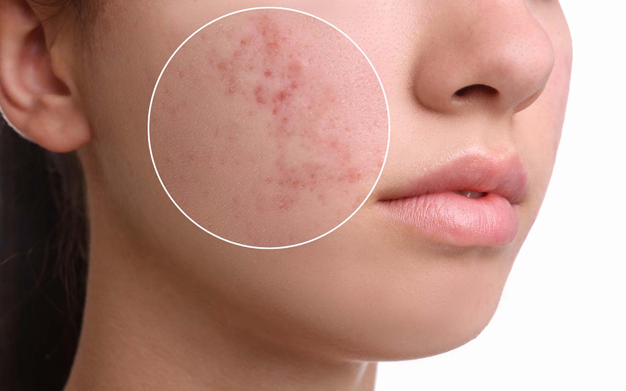 3 stages of the chronic skin condition, acne. Scars treatment in Honolulu can be evaluated by Dr. Tan. Treating acne scars in Hawaii. Acne scar treatment, Honolulu.