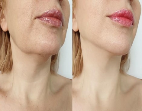 Reduce or remove turkey neck from jowls with Honolulu HIFU treatments.