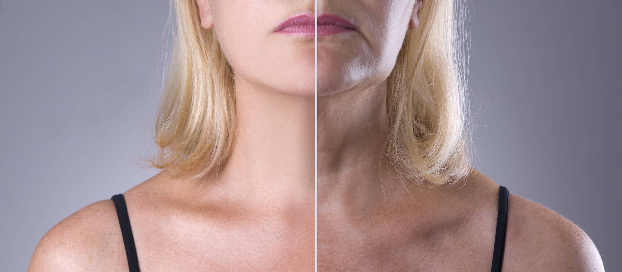 Before and after, deep plane facelift surgery, Honolulu, HI.