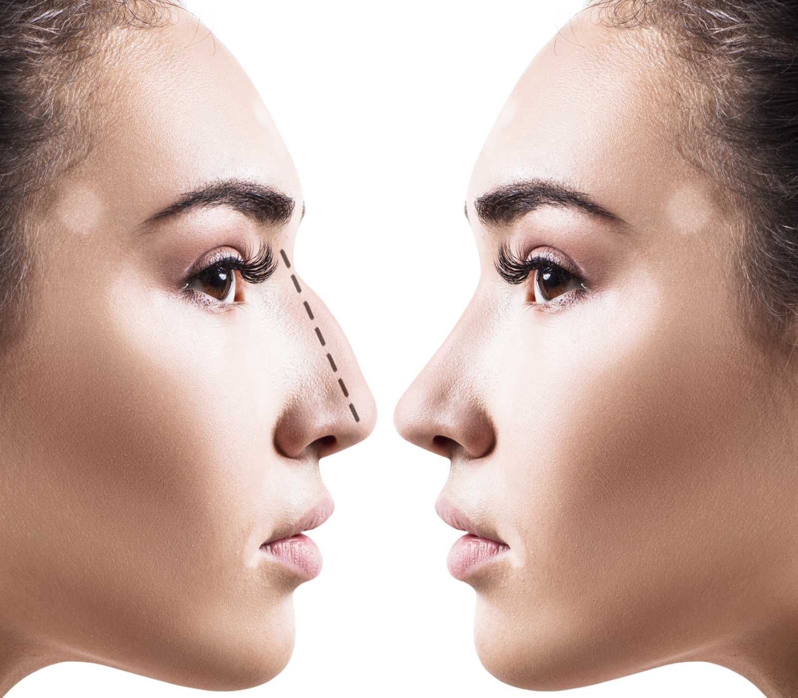 Areas of improvement, Honolulu non-surgical rhinoplasty injectables, Hawaii.