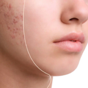 Before and after results of laser acne peel, Honolulu. Treatment for acne scarring, Hawaii.