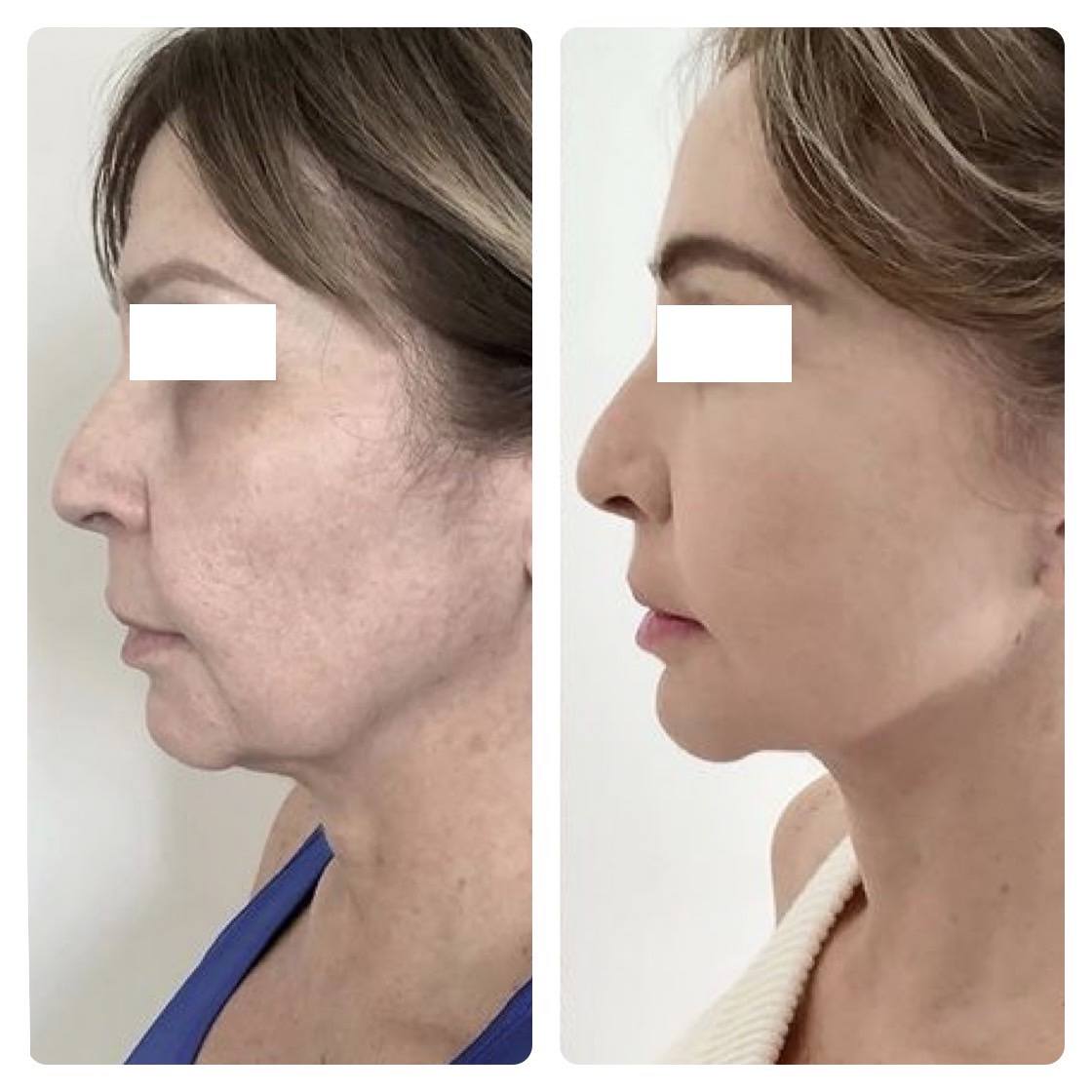 Deep Plane Face and Neck Lift Treatment