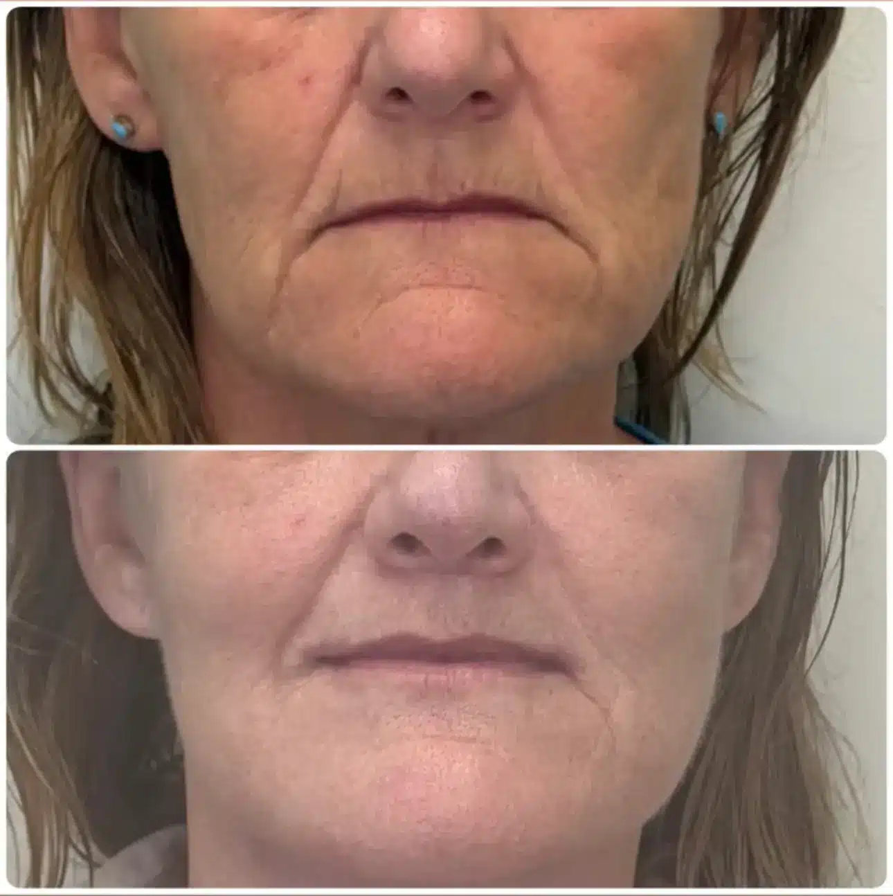 image4.jpeg Corner lip lift in Hawaii elevates the corners of the mouth to raise downward turning lips. Fixing sad or tired appearances with lip surgery in Honolulu.
