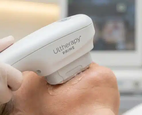 Close-up of a practitioner applying the Ultherapy PRIME handpiece to a patient's jawline to stimulate collagen for non-surgical skin tightening.