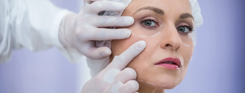 A female patient with surgical markings on her face during a facelift consultation with a Hawaii facial plastic surgeon.