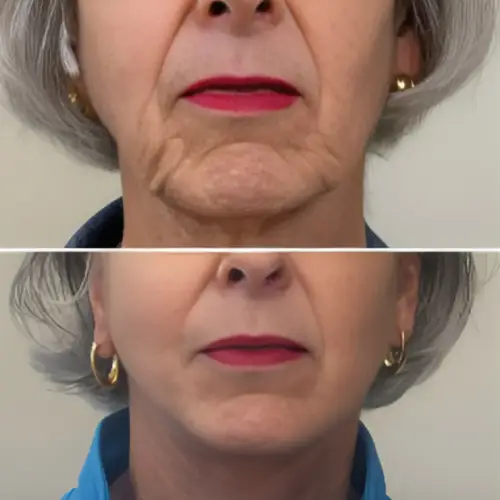 Before and after facelift results for a woman over 50, showcasing a rejuvenated jawline and neck lift contouring in Hawaii.