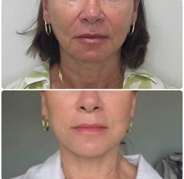 Lower facelift and neck lift before and after photos showing significant jowl reduction and smoother skin after recovery.