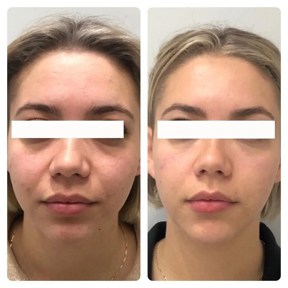 Hawaii Facial Plastic Surgery before and after display how natural-looking facial rejuvenation can enhance aesthetics without creating an overdone look.