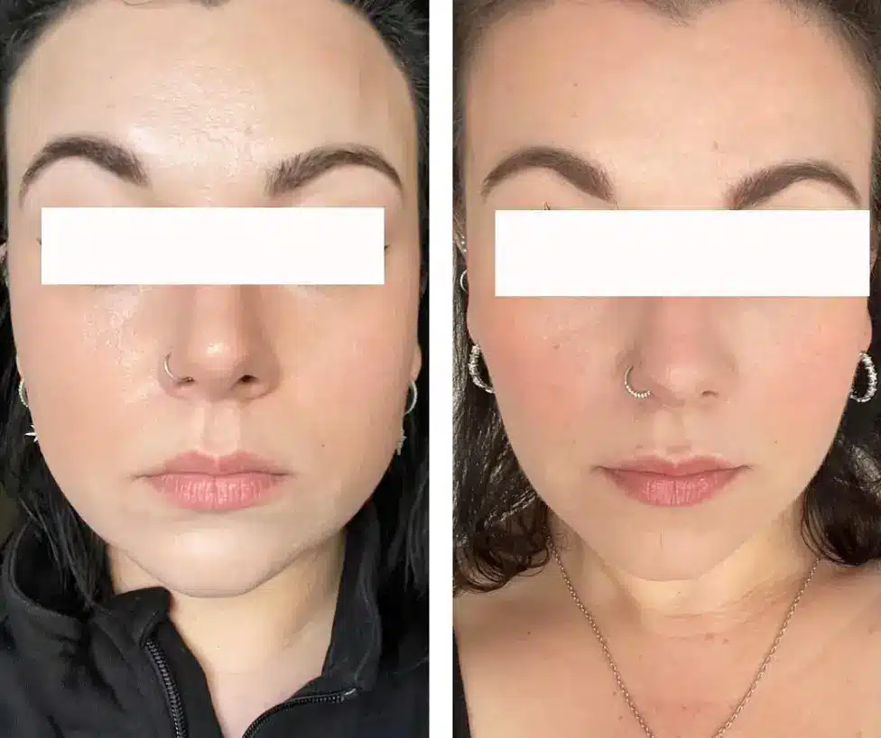 Before and after showcasing subtle, natural facial rejuvenation and lifting that results in balanced features. Procedure performed at Hawaii Facial Plastic Surgery.
