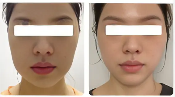 Comparison of results from facial fat grafting vs dermal fillers treatments in Hawaii. 