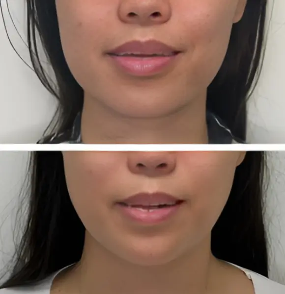Top and bottom before and after close-up photos of a woman’s lower face, highlighting enhanced perioral skin texture and subtle lip volume after a nanofat treatment.