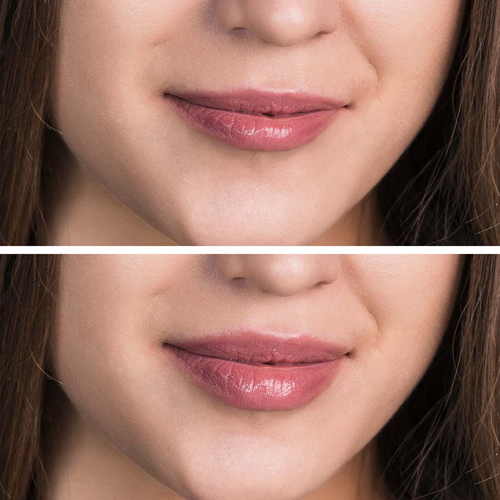 Before and after of treatment with injectable lip filler, Restylane® Kysse, highlight restored lip volume while maintaining natural looking results.