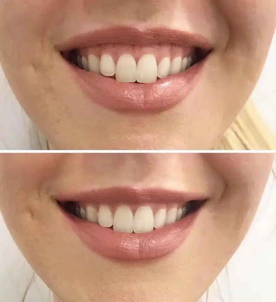 Before and after results of a Hawaii lip filler treatment showcasing improved moisture and volume. 