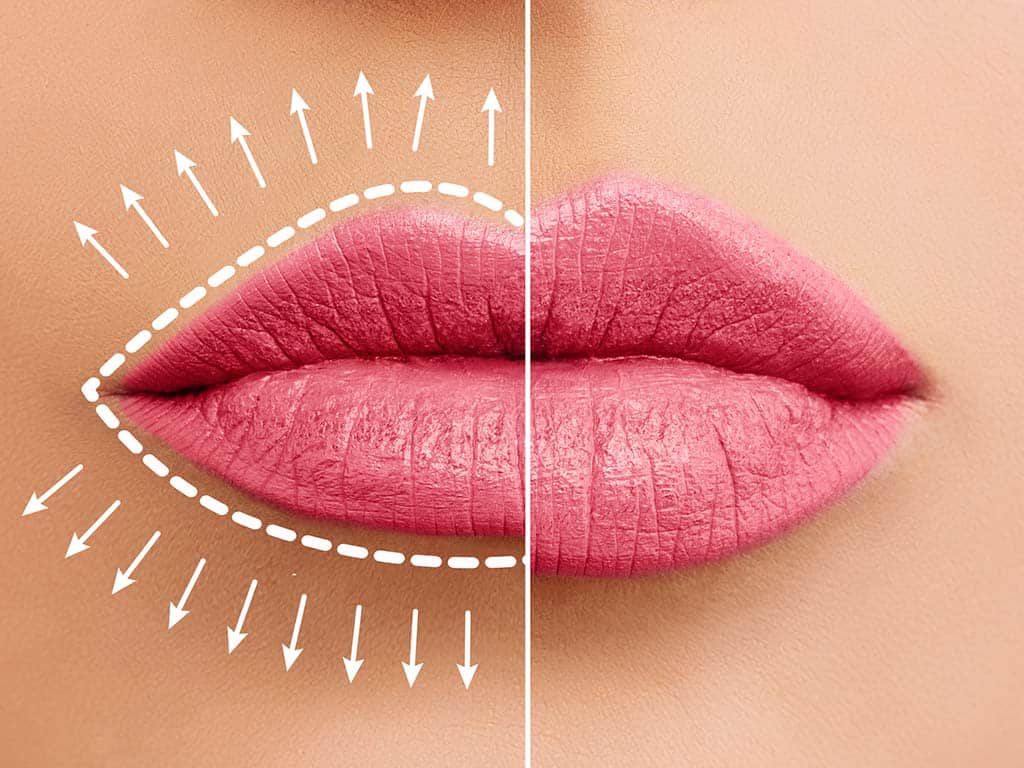 Diagram displaying fuller lips after a Honolulu injectable lip filler treatment at Hawaii Facial Plastic Surgery.