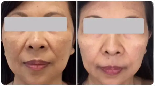 Before and after photos of a female patient’s lower face demonstrating safe improvements in skin texture, tone, and faded hyperpigmentation after SkinPen treatments in Honolulu.