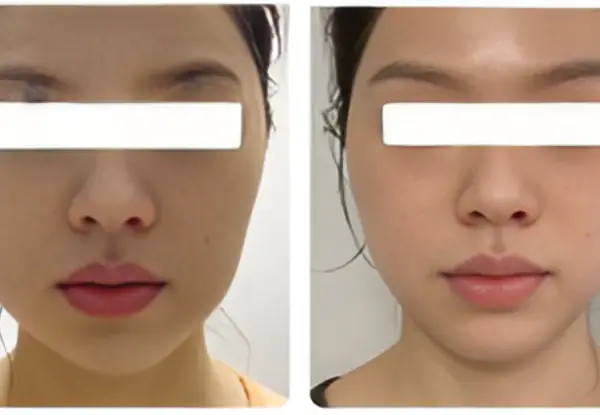 Side-by-side before and after photos of a female patient with white privacy bars over her eyes, demonstrating natural-looking facial volume restoration as a longer-lasting alternative to dermal fillers.