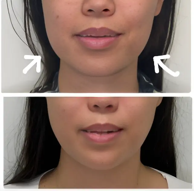 Facial recovery and aftercare following fat grafting procedure and injections with dermal fillers in Honolulu, HI.
