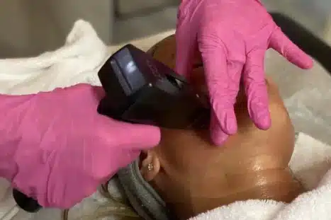 Morpheus8 (RF Microneedling) treatment used to stimulate collagen remodeling in the dermis skin layer.
