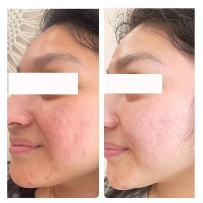 Benefits of SkinPen PRP treatments include faster healing for hyperpigmentation and acne scarring.